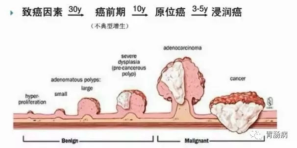 體檢查出腸息肉一定要切除！ 95%腸癌由它演變而來