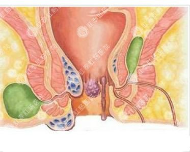 南寧哪個醫(yī)院可以做肛周膿腫？
